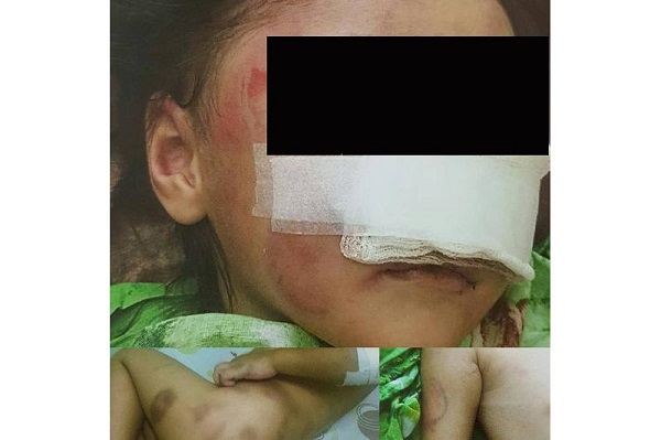 Алматы облысында өгей әке үш жасар қызын тістелеп, мұрнын жұлып алды